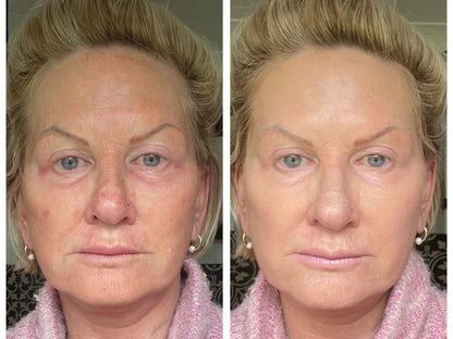 PDRN Hyaluronic Acid 100+ Moisturizing Cream — Wrinkle Smoothing & Restorative Care (60ml)